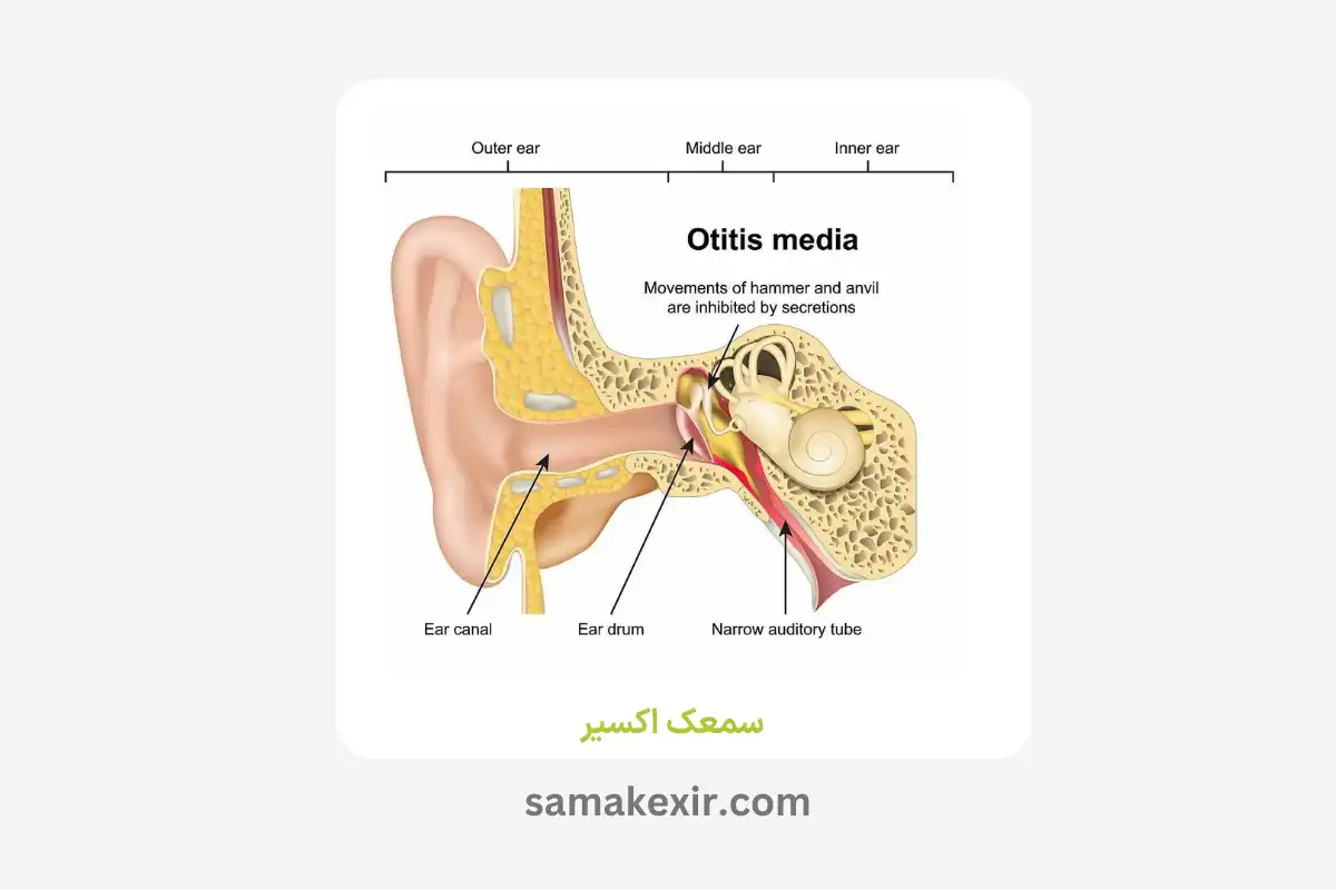 علت و تشخیص عفونت گوش میانی