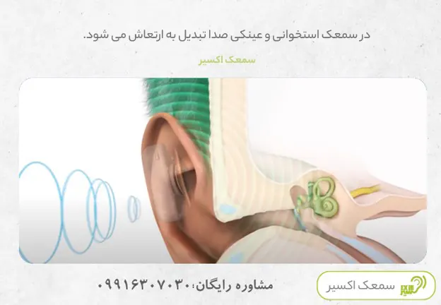 The best hearing aid for ossicular adhesions