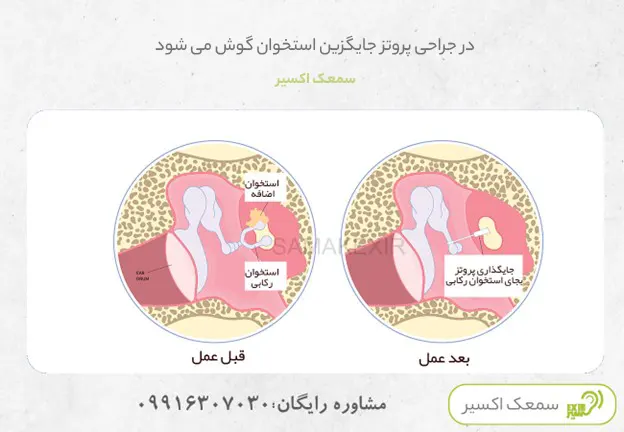 درمان اتواسکلروزیس 