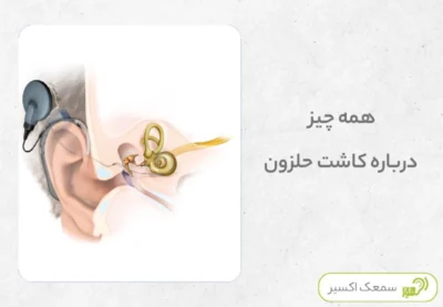 کاشت حلزون