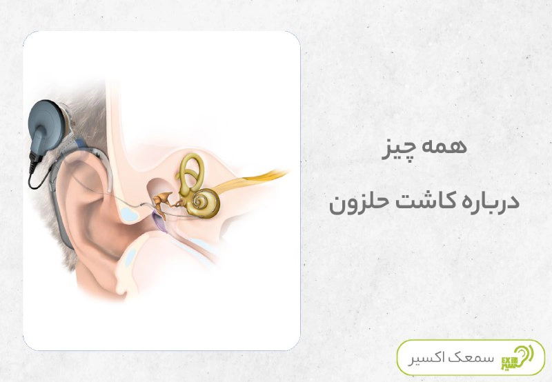 کاشت حلزون
